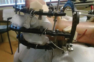 Jacob’s ankle during treatment with external fixation