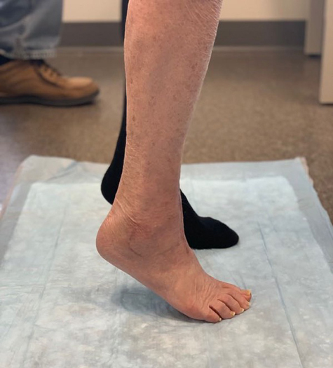 Sharon’s foot after ankle replacement